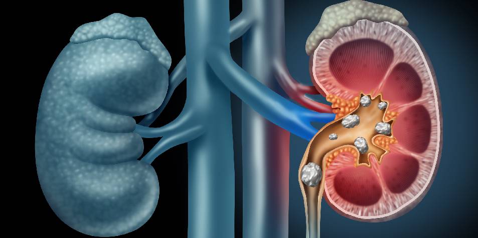 ¿Cuáles son los primeros síntomas de cálculos renales y cómo prevenirlos?