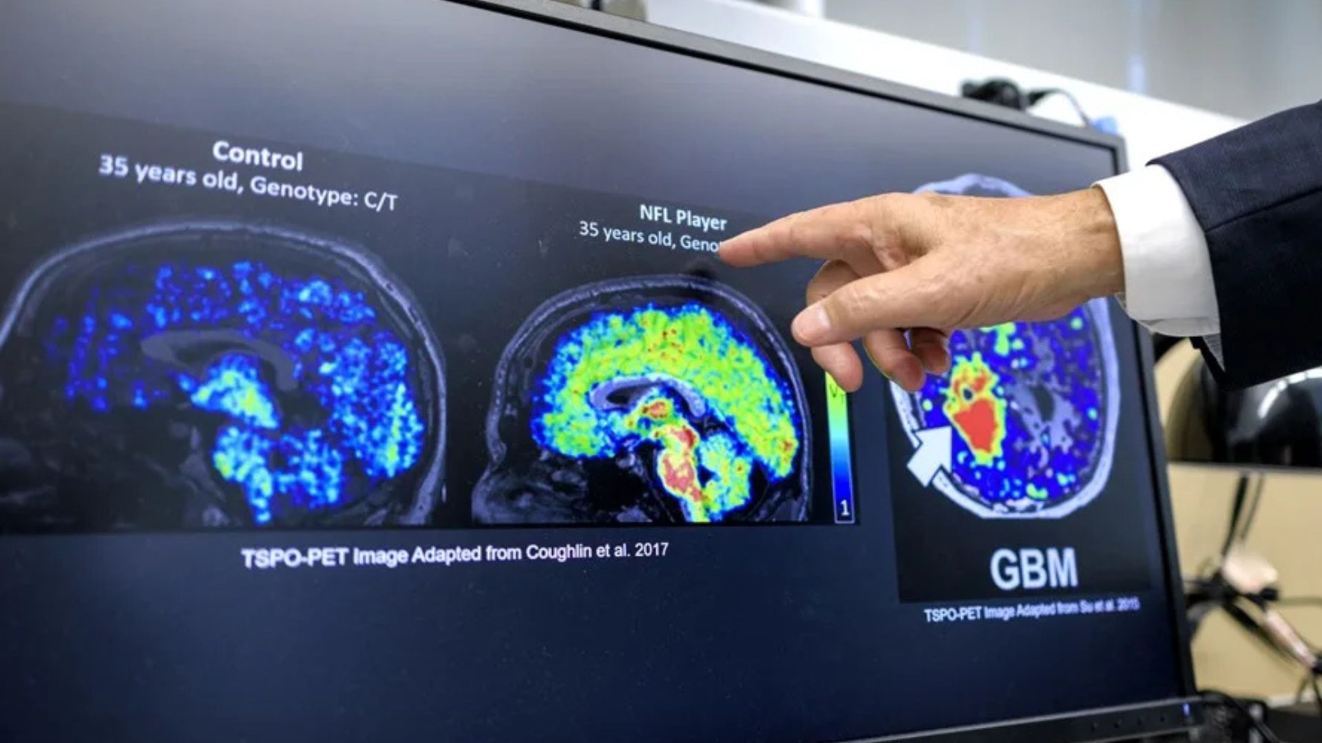 Científicos latinos hallan un biomarcador que podría detectar temprano el Alzheimer