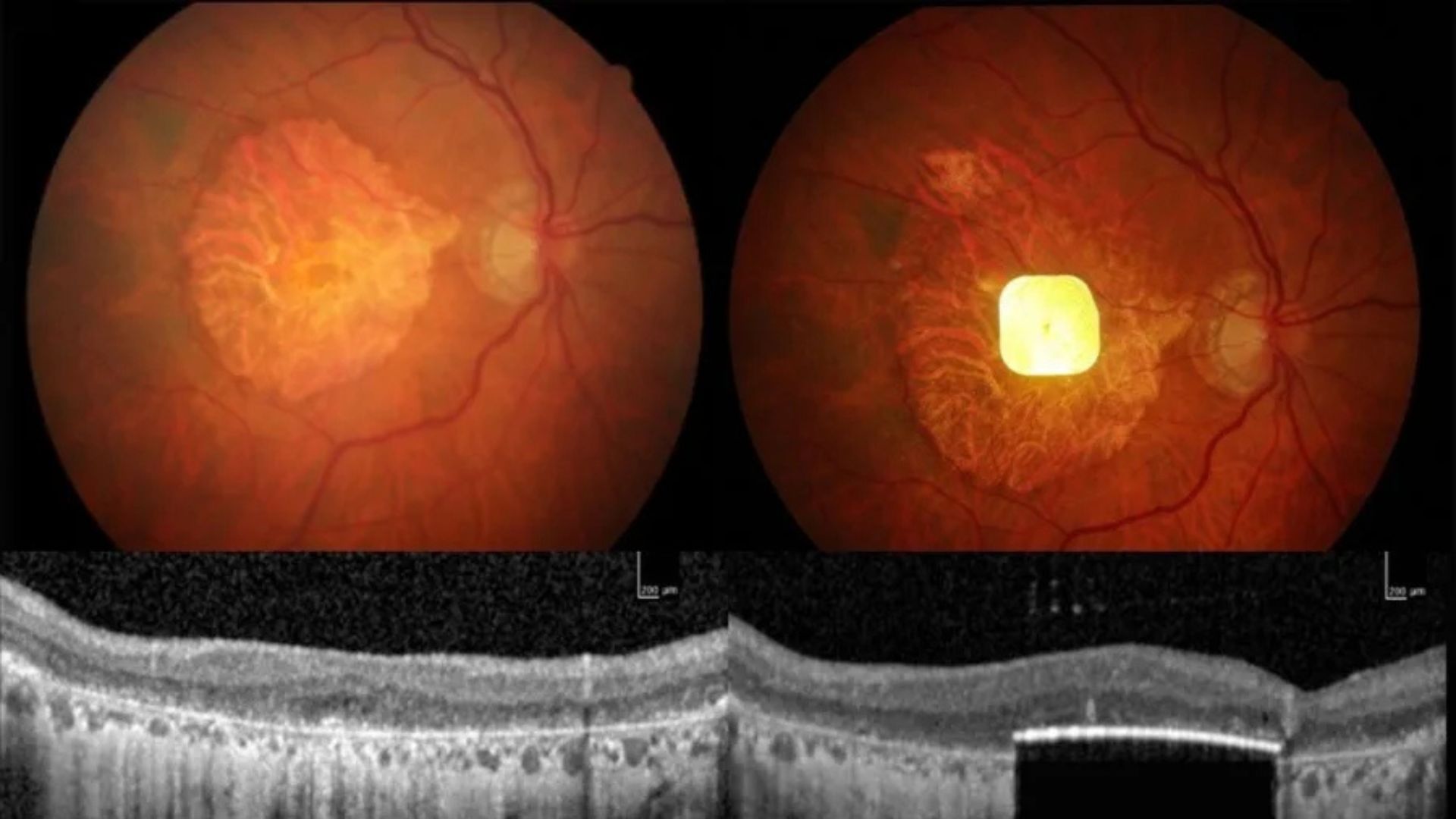 Una prótesis ocular permite leer a personas con ceguera irreversible