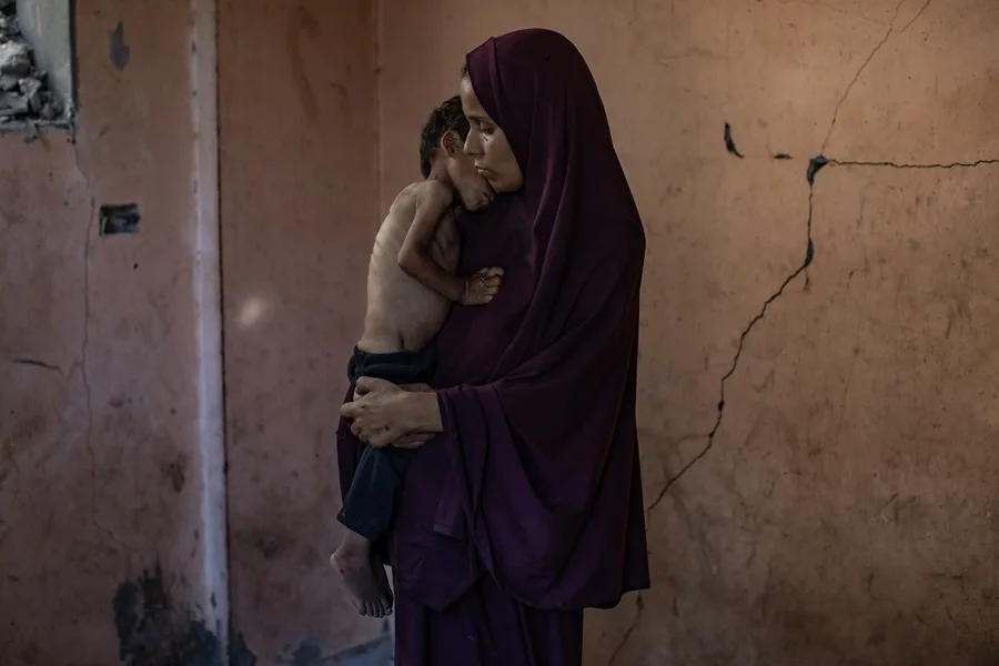 Más de 54.600 niños gazatíes sufren desnutrición severa, 12.800 muy grave