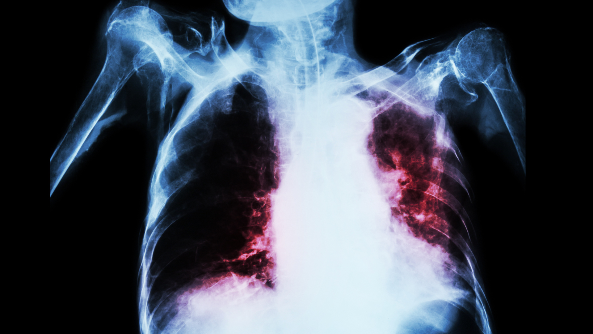 Las muertes por tuberculosis bajan un 3 %, sigue siendo la infección más mortal