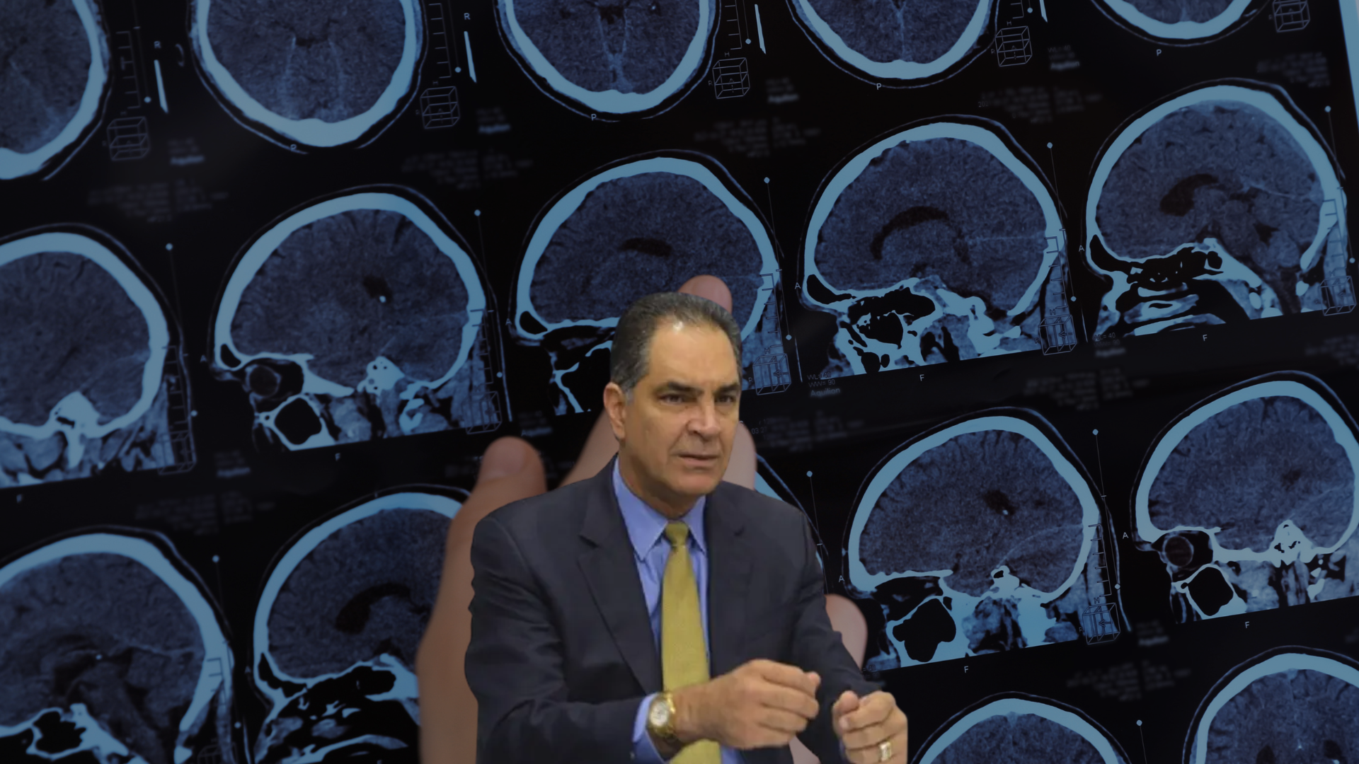 ¿Qué es la esclerosis múltiple? La enfermedad que presenta la defensa de Hazim para evitar prisión preventiva