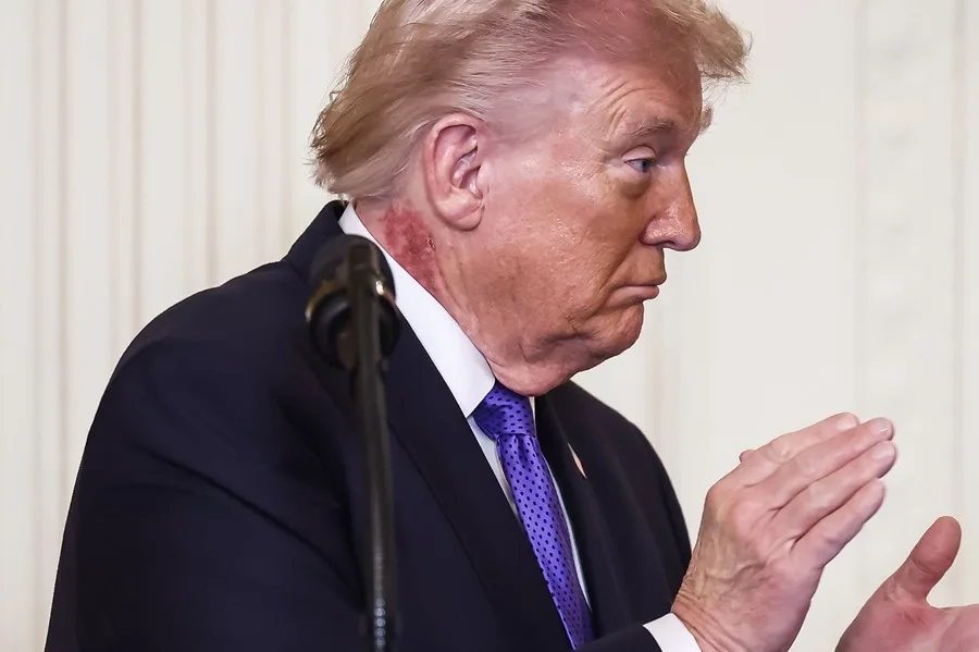 Trump aparece con sarpullido en el cuello y su médico lo atribuye a un tratamiento preventivo
