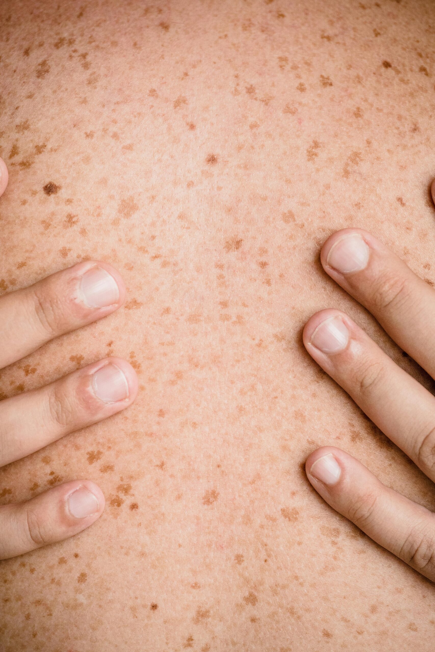 El cáncer de piel va en aumento en RD: ¿Qué recomiendan los expertos para que te protejas?