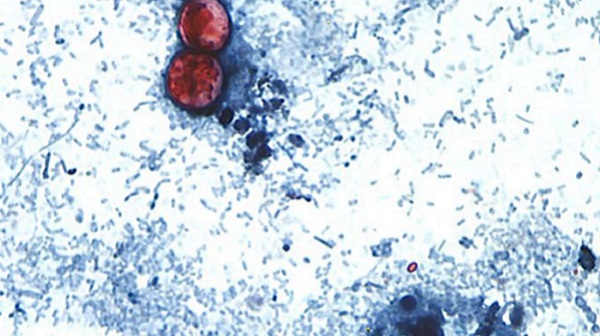 Ciclosporosis: diagnóstico difícil y tratamiento eficaz para una infección intestinal