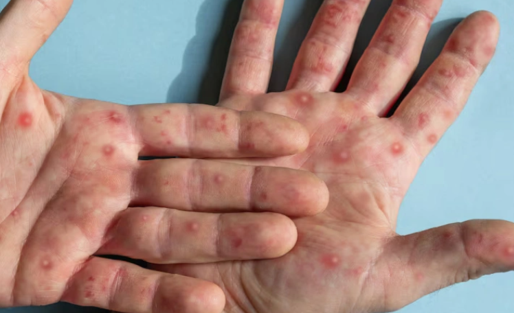 Viruela símica ¿Cómo se contagia? hay dos casos en RD