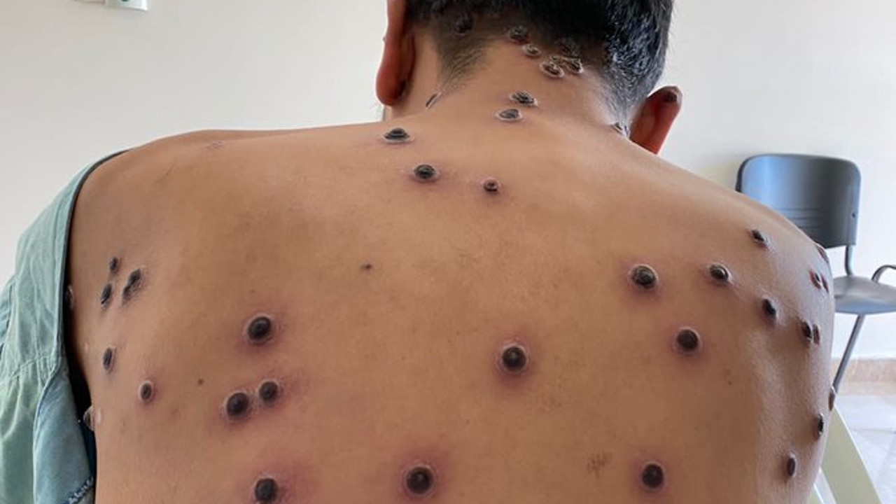 Viruela símica: qué es, cómo se transmite, síntomas y cómo prevenirla